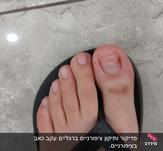 כף רגל עם ציפורניים לא מטופלות בסנדל שחור